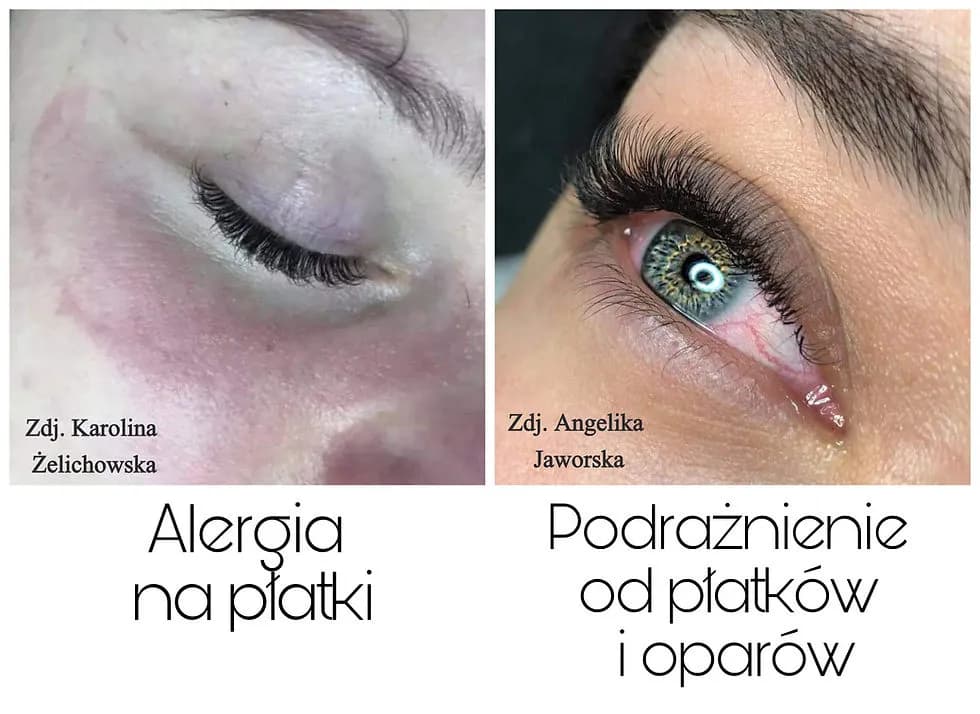 Alergia na rzęsy: objawy, kiedy występuje i co robić?