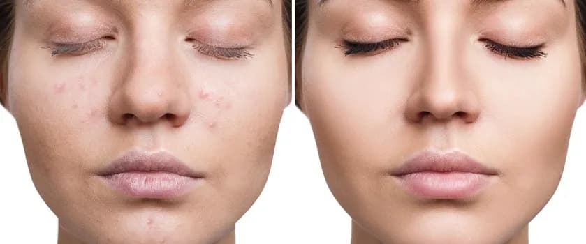 Jak rozjaśnić cerę? Skuteczne metody na przebarwienia i plamy