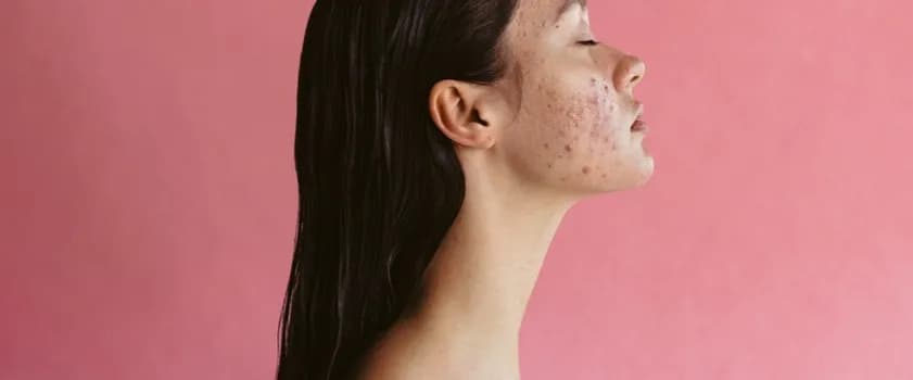 Jak pozbyć się zaczerwienienia po wyciśnięciu pryszcza? Szybkie metody