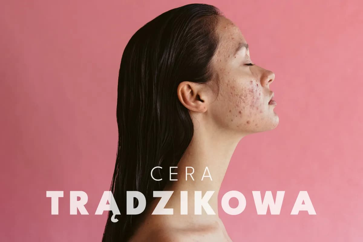 Cera trądzikowa: Jak skutecznie poprawić jej stan? Poradnik