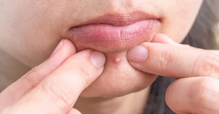 Bolesny pryszcz podskórny: Szybkie i bezpieczne sposoby na pozbycie się go