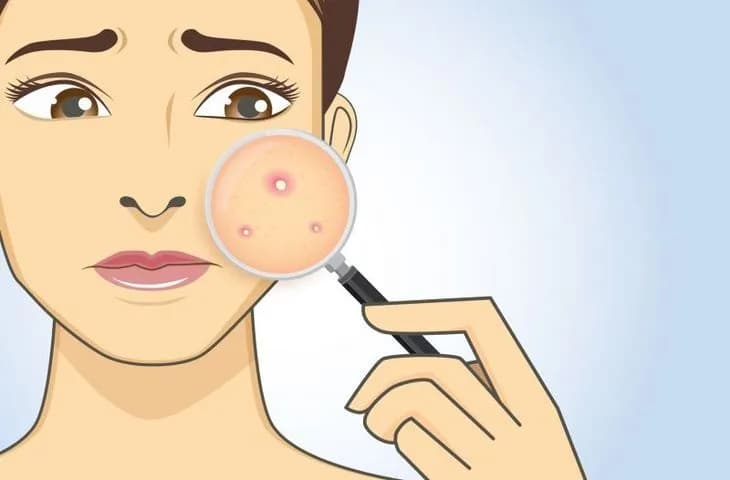 Maść Ichtilowa na Pryszcze: Jak Stosować? Instrukcja Krok po Kroku