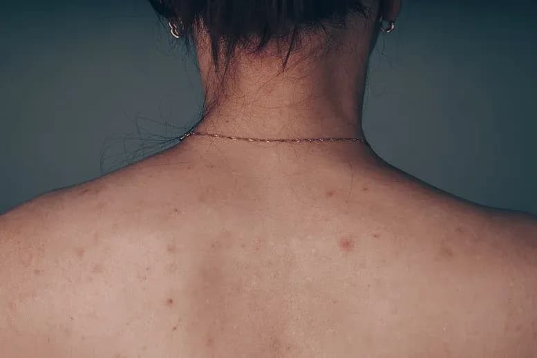 Pryszcze na plecach: przyczyny, dieta, pielęgnacja i skuteczne metody