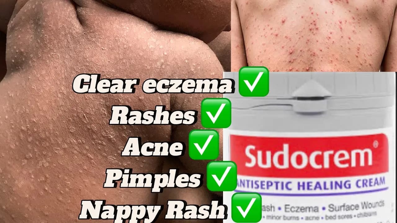 Sudocrem na pryszcze: Czy działa? Jak stosować bezpiecznie?
