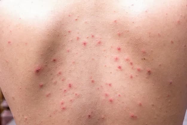 Jak pozbyć się pryszczy na plecach? Kompleksowy poradnik