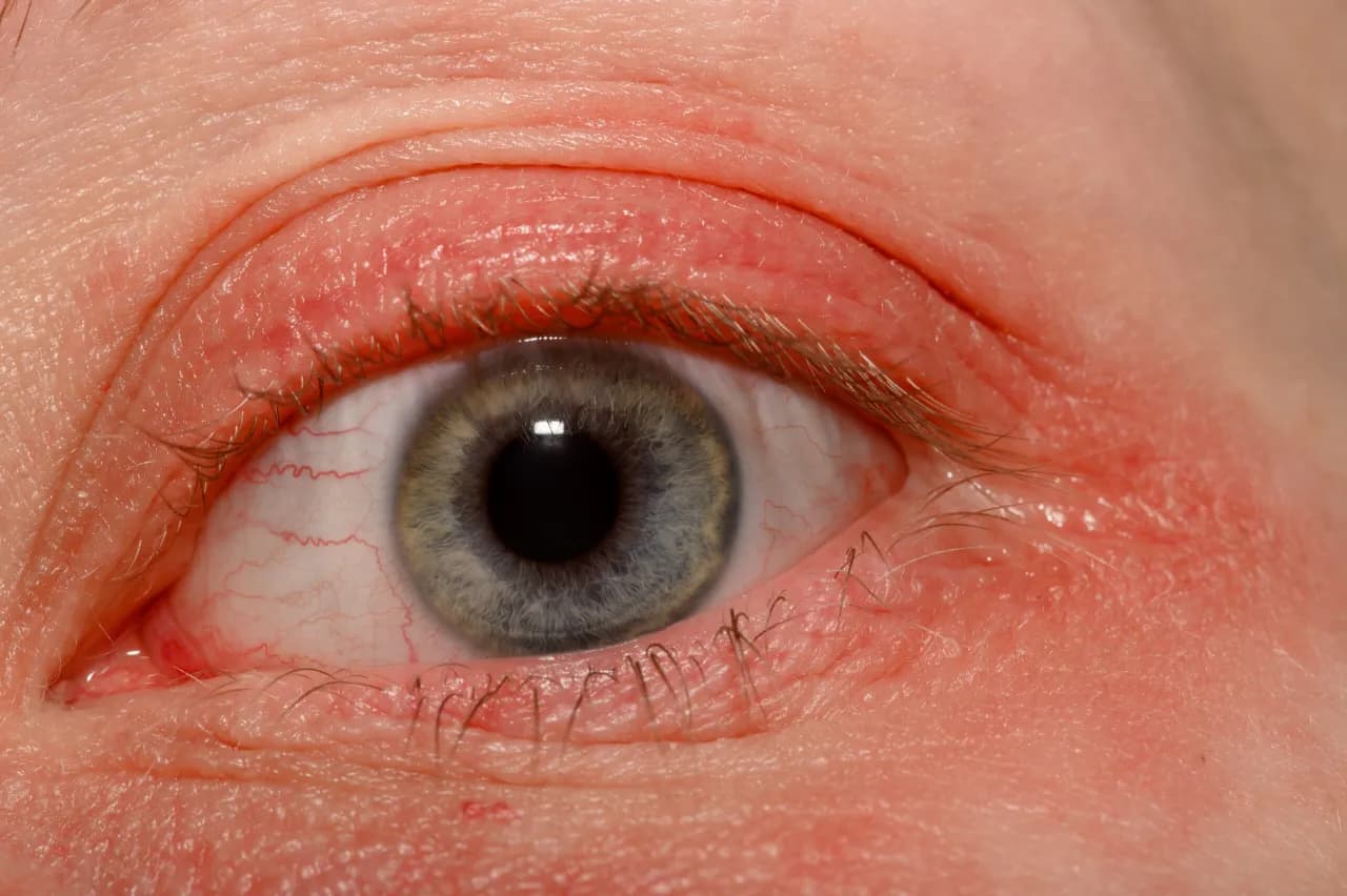 Uczulenie na klej do rzęs: objawy, różnice, leczenie